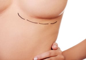 Woman breast marked out for cosmetic surgery. Isolated on white.