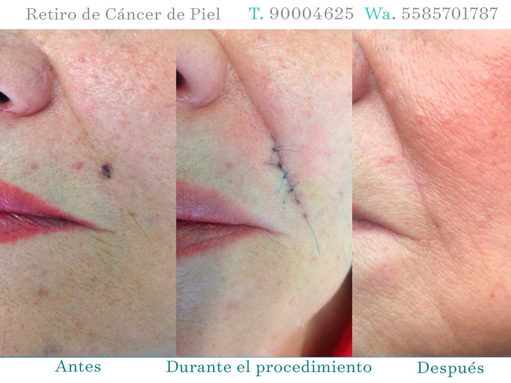CÁNCER DE PIEL BEFORE AND AFTER