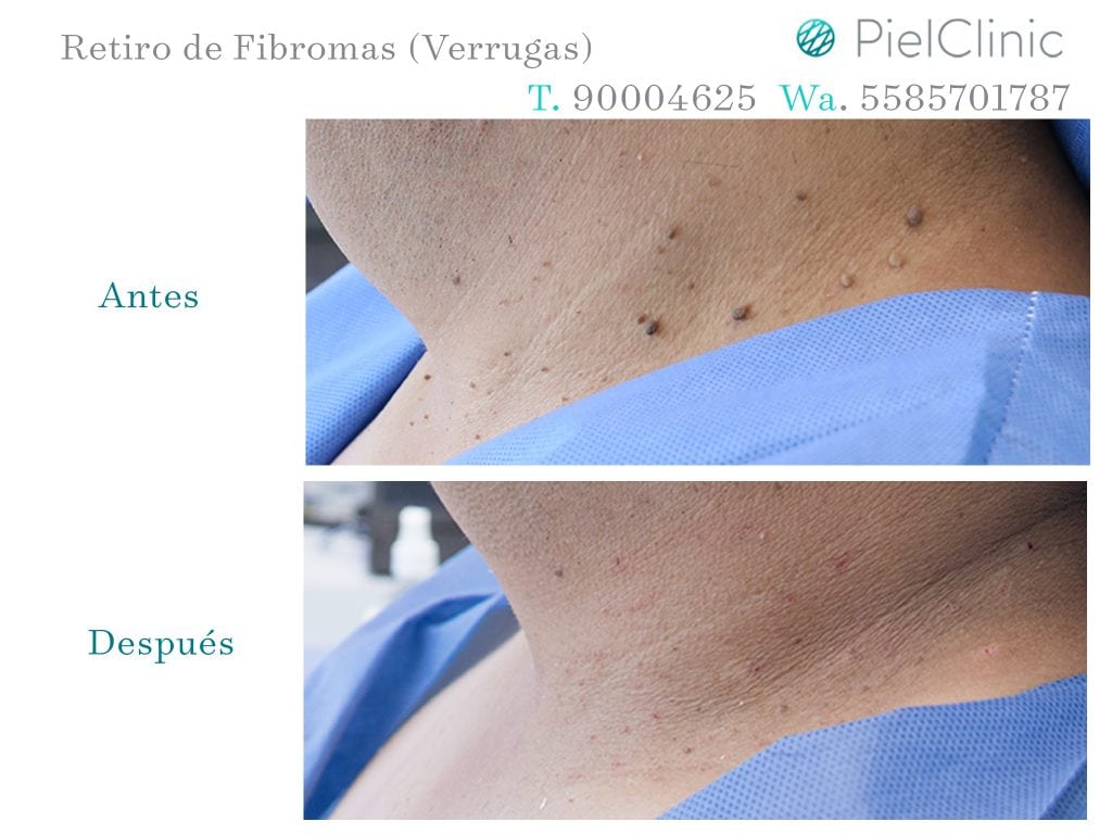 FIBROMAS BEFORE AND AFTER