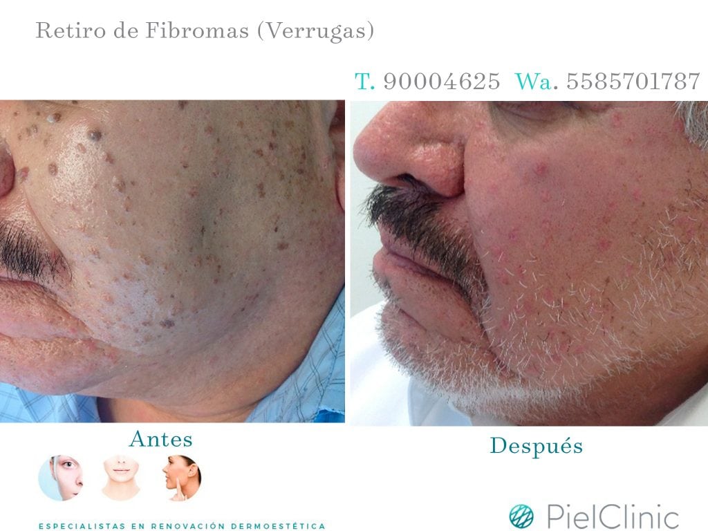 FIBROMAS BEFORE AND AFTER 2
