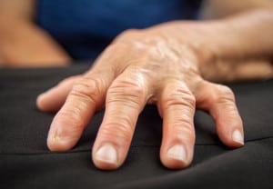Rheumatoid arthritis hand