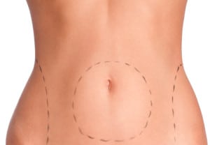 Belly plastic correction, isolated, white background