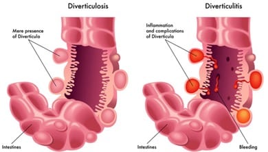 diverticulo1