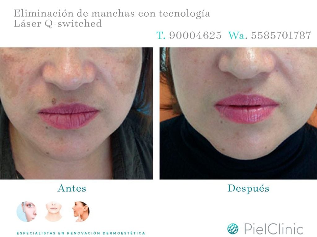 MANCHAS BEFORE AND AFTER