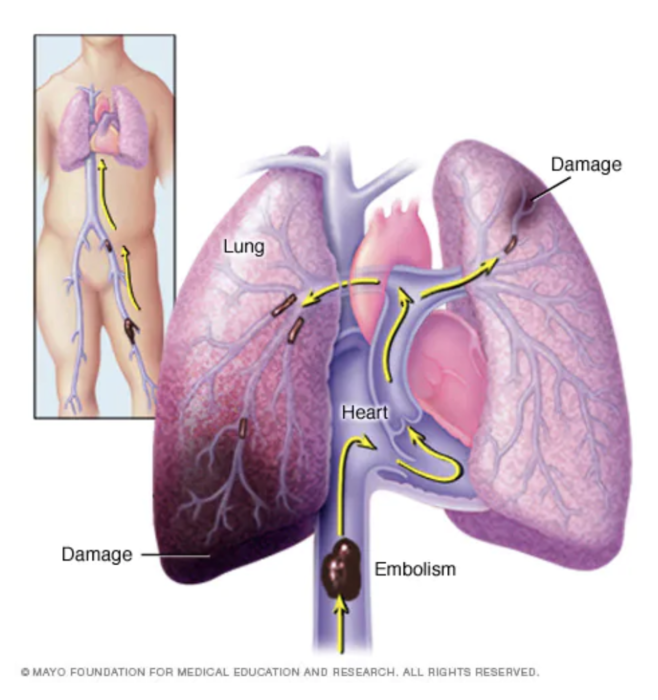 trombosis pulmonar mayo clinic qué es