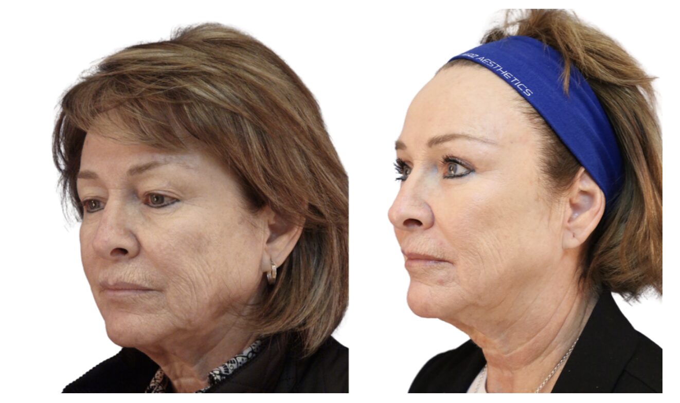 Blefaroplastia