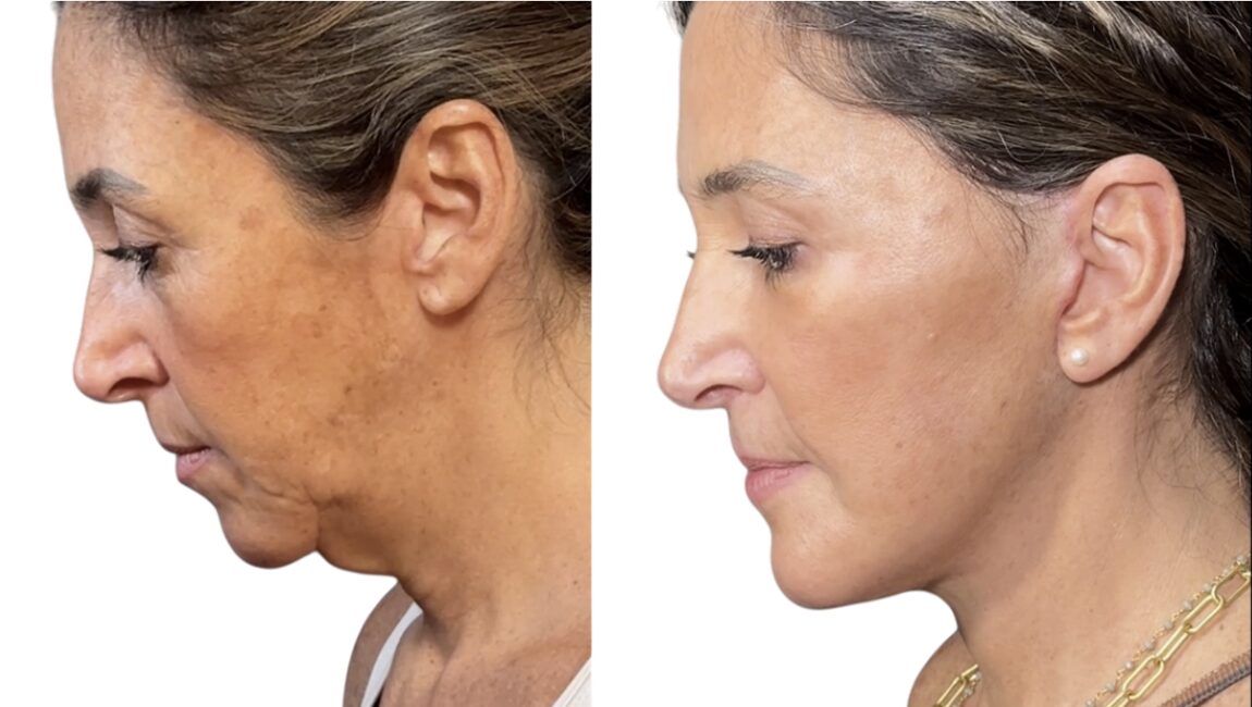 facelift