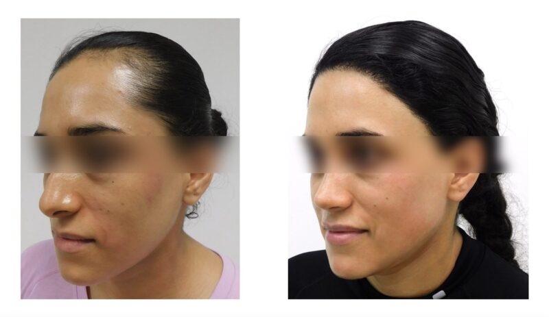 injerto de pelo en mujeres