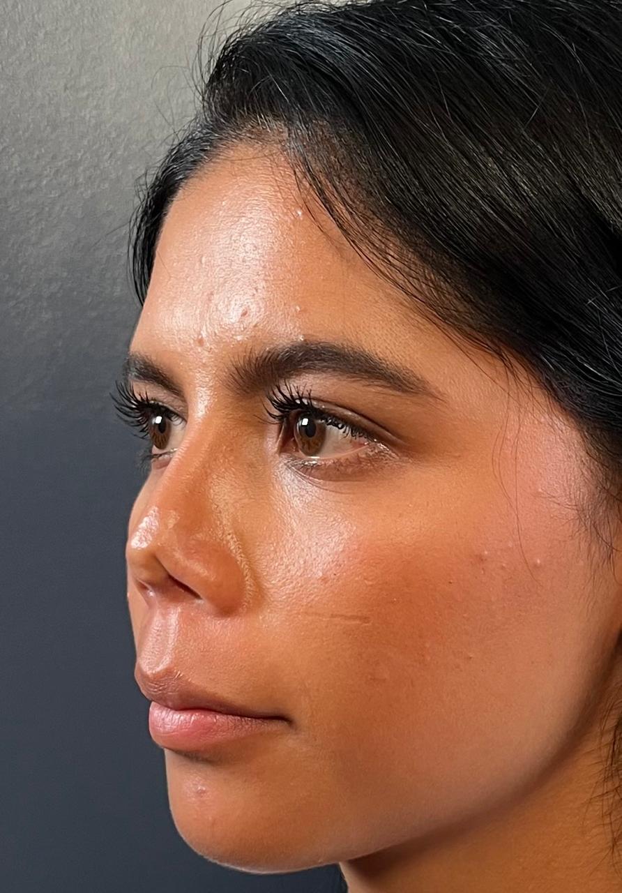 un mal resultado en una rinoplastia
