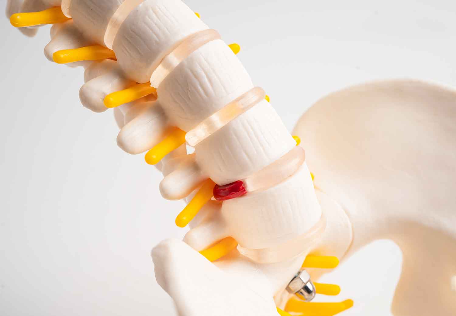 hernia-de-disco-martha-debayle