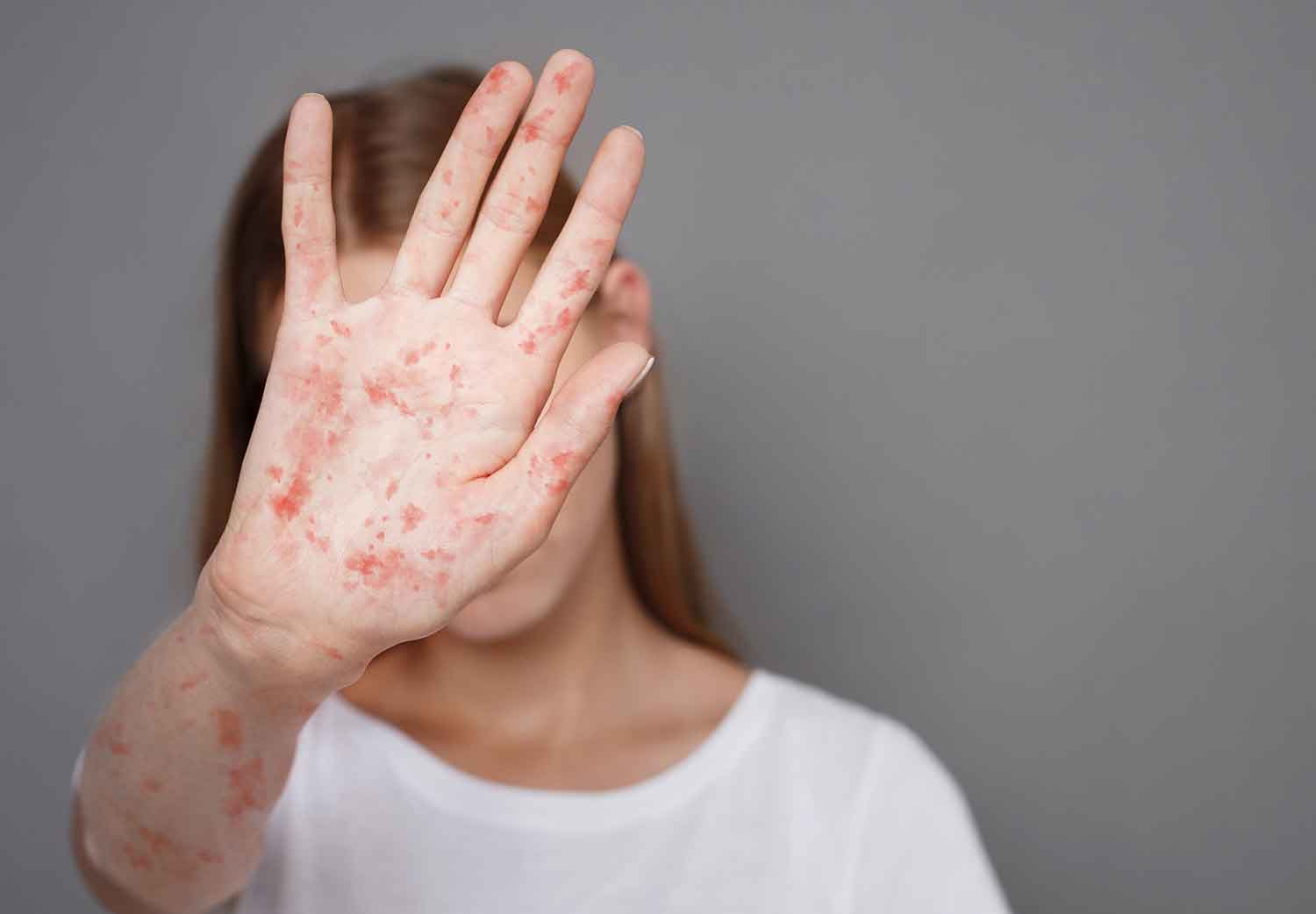 quien-se-debe-de-vacunar-contra-el-sarampion