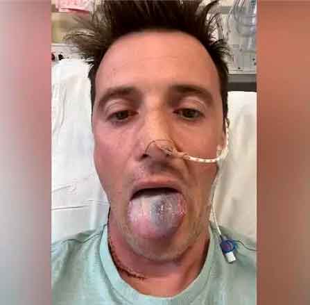 anthony-perrin-vph-cancer-de-lengua